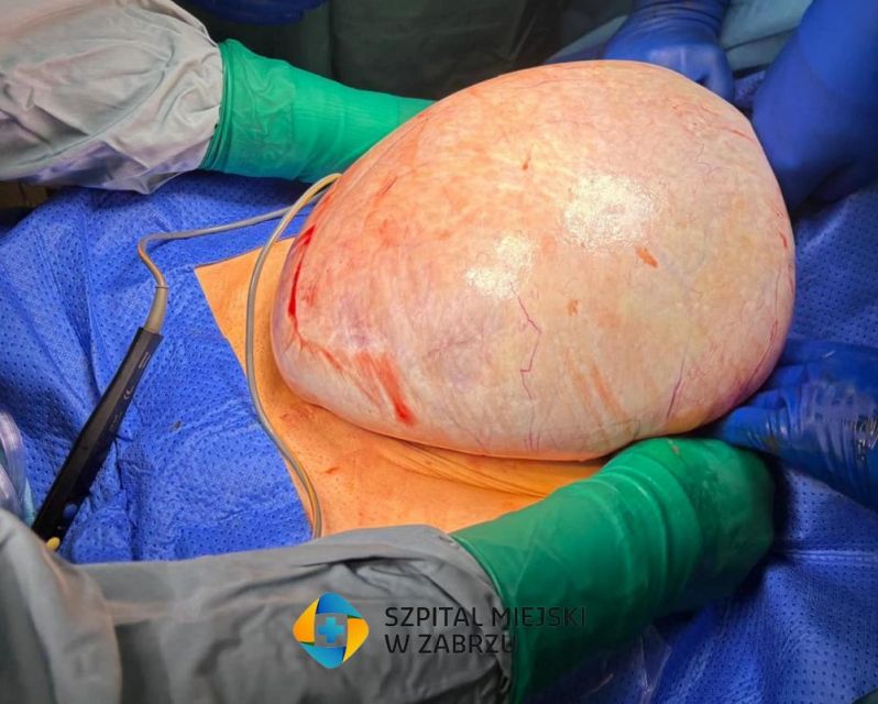 Sukces lekarzy z Zabrza! Usunęli 8-kilogramowego guza i uratowali życie pacjentki - galeria